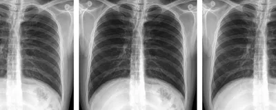 A panel of three abdominal X-rays that look exactly the same, indicating that the authors of the retracted paper likely copied the image to publish it as their own.