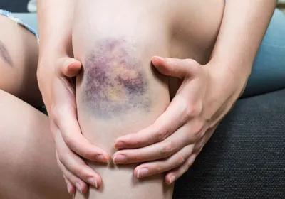 A bruise on a person’s knee, with varying hues of black, blue, and yellow. 