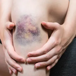 A bruise on a person’s knee, with varying hues of black, blue, and yellow. 