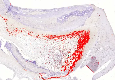 Asymptomatic bacterial biofilm (red) lining a cholesterol-laden coronary artery plaque.