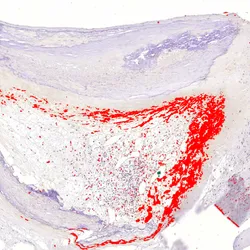 Asymptomatic bacterial biofilm (red) lining a cholesterol-laden coronary artery plaque. Asymptomatic bacterial biofilm (red) lining a cholesterol-laden coronary artery plaque.