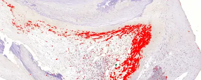 Asymptomatic bacterial biofilm (red) lining a cholesterol-laden coronary artery plaque.