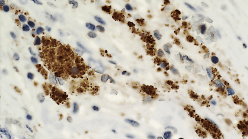 Streptococci bacteria (brown) in the wall of a ruptured coronary plaque.