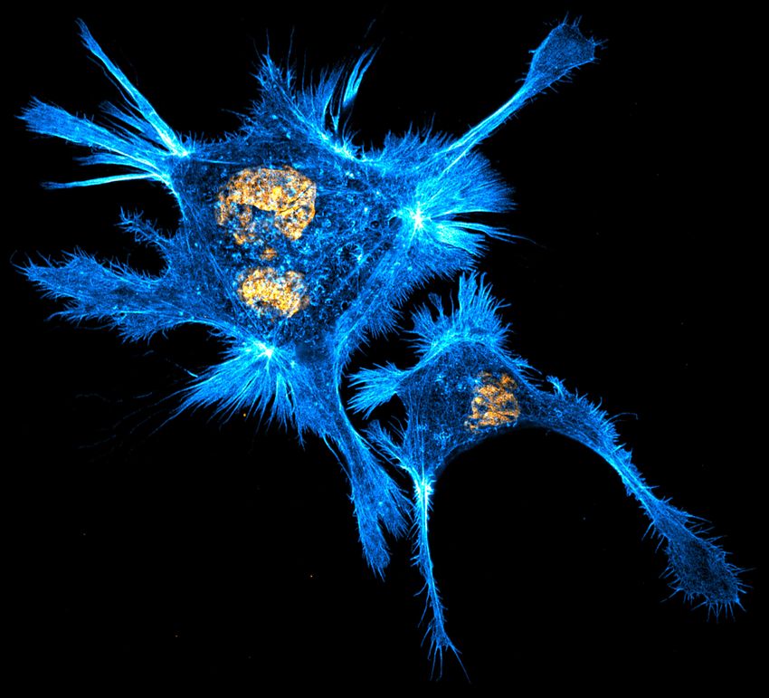 Image of two human liver cancer (HepAD38) cells with actin protrusions (blue) along the perimeter. The cellular DNA is stained in orange. Image of two human liver cancer (HepAD38) cells with actin protrusions (blue) along the perimeter. The cellular DNA is stained in orange.