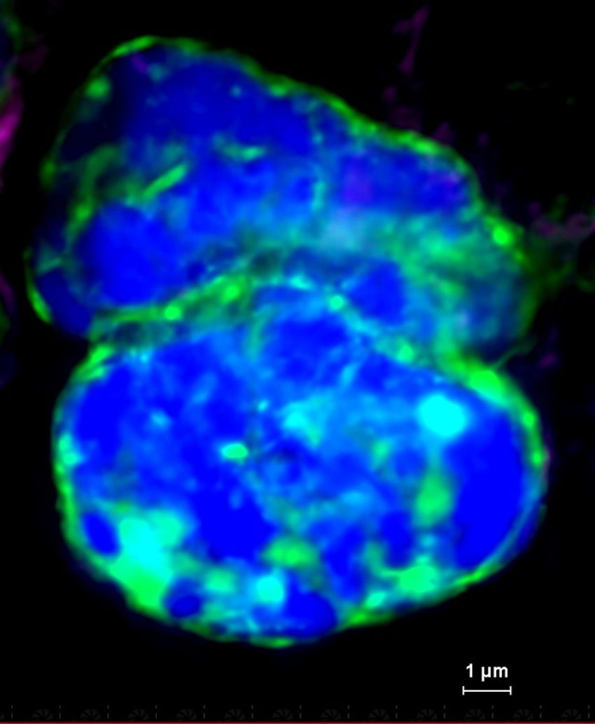A microscopy image showing a lumpy circulating tumor cell, with blue and green fluorescence.