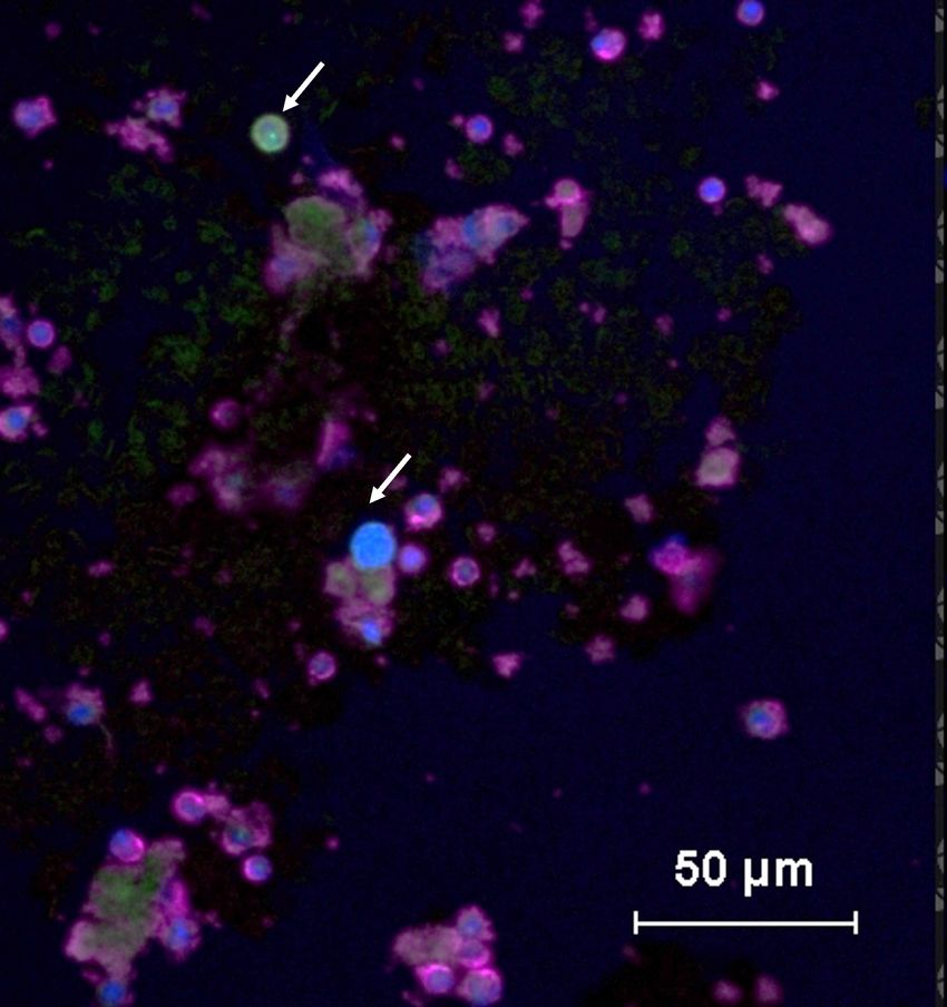 A microscope image showing glowing green circulating tumor cells and purple healthy cells in a blood sample.