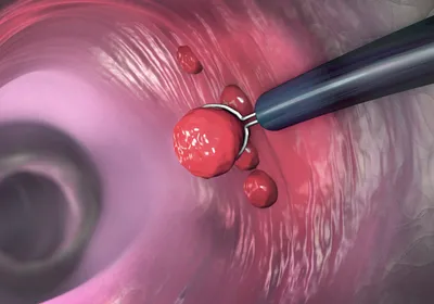 An image shows the removal of a potential cancerous polyp during a colonoscopy. An image shows the removal of a potential cancerous polyp during a colonoscopy.