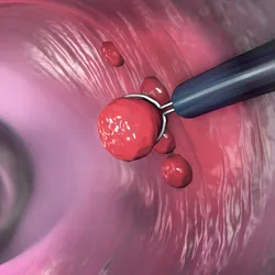 An image shows the removal of a potential cancerous polyp during a colonoscopy. An image shows the removal of a potential cancerous polyp during a colonoscopy.