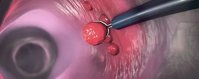 An image shows the removal of a potential cancerous polyp during a colonoscopy.