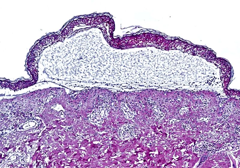 Processed Skin Spatial Proteomics Identifies JAKi As Treatment for a Deadly Skin ...