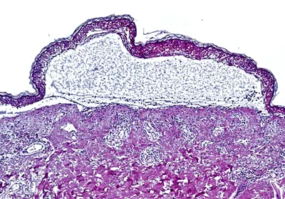A histology-stained cross-section through the skin shows the detachment of the epidermis seen in toxic epidermal necrolysis. A histology-stained cross-section through the skin shows the detachment of the epidermis seen in toxic epidermal necrolysis.