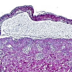A histology-stained cross-section through the skin shows the detachment of the epidermis seen in toxic epidermal necrolysis. A histology-stained cross-section through the skin shows the detachment of the epidermis seen in toxic epidermal necrolysis.