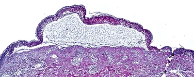 A histology-stained cross-section through the skin shows the detachment of the epidermis seen in toxic epidermal necrolysis.