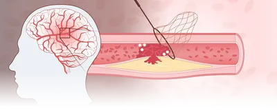 Image of a human head with a focus on the brain. There is a zoom out box that leads into a section of a blood vessel. This blood vessel is blocked with red blood cells and white blood cells, resulting in decreased blood flow. Image of a human head with a focus on the brain. There is a zoom out box that leads into a section of a blood vessel. This blood vessel is blocked with red blood cells and white blood cells, resulting in decreased blood flow.