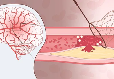 Image of a human head with a focus on the brain. There is a zoom out box that leads into a section of a blood vessel. This blood vessel is blocked with red blood cells and white blood cells, resulting in decreased blood flow. Image of a human head with a focus on the brain. There is a zoom out box that leads into a section of a blood vessel. This blood vessel is blocked with red blood cells and white blood cells, resulting in decreased blood flow.