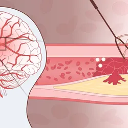 Image of a human head with a focus on the brain. There is a zoom out box that leads into a section of a blood vessel. This blood vessel is blocked with red blood cells and white blood cells, resulting in decreased blood flow.