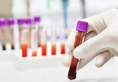 Photograph of a person wearing a white nitrile glove holding a clear tube with a purple cap that has dark red blood in the bottom. This illustrates the use of blood proteins to study disease biomarkers. 