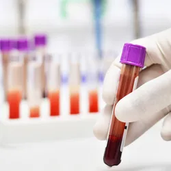 Photograph of a person wearing a white nitrile glove holding a clear tube with a purple cap that has dark red blood in the bottom. This illustrates the use of blood proteins to study disease biomarkers. Photograph of a person wearing a white nitrile glove holding a clear tube with a purple cap that has dark red blood in the bottom. This illustrates the use of blood proteins to study disease biomarkers.