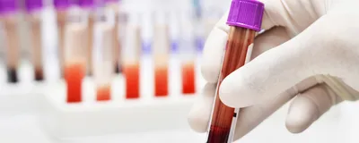 Photograph of a person wearing a white nitrile glove holding a clear tube with a purple cap that has dark red blood in the bottom. This illustrates the use of blood proteins to study disease biomarkers. Photograph of a person wearing a white nitrile glove holding a clear tube with a purple cap that has dark red blood in the bottom. This illustrates the use of blood proteins to study disease biomarkers.