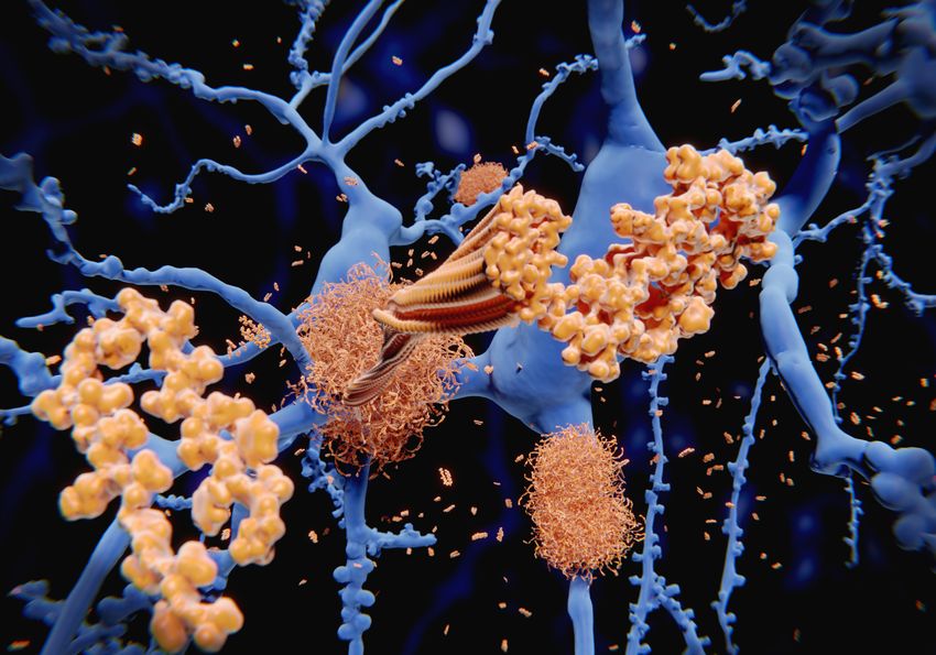 Graphic of amyloid plaques forming amongst neurons during Alzheimer’s disease Graphic of amyloid plaques forming amongst neurons during Alzheimer’s disease