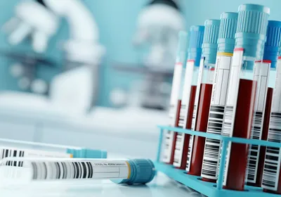 Blood sample tubes sit in a rack on a laboratory bench.