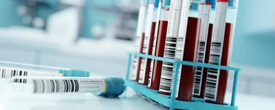 Blood sample tubes sit in a rack on a laboratory bench.