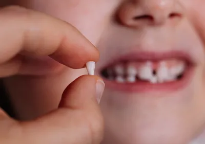 A child holds one of her baby teeth that fell out between her thumbs while smiling with a gap in her teeth. 