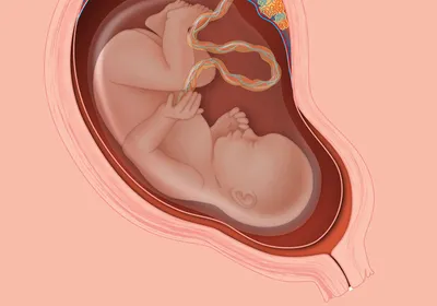 Illustration of a uterus with a near-term fetus inside of it, surrounded by the amniotic sac that will be filled with amniotic fluid. The placenta is at the top of the uterus, with red and blue veins and arteries.