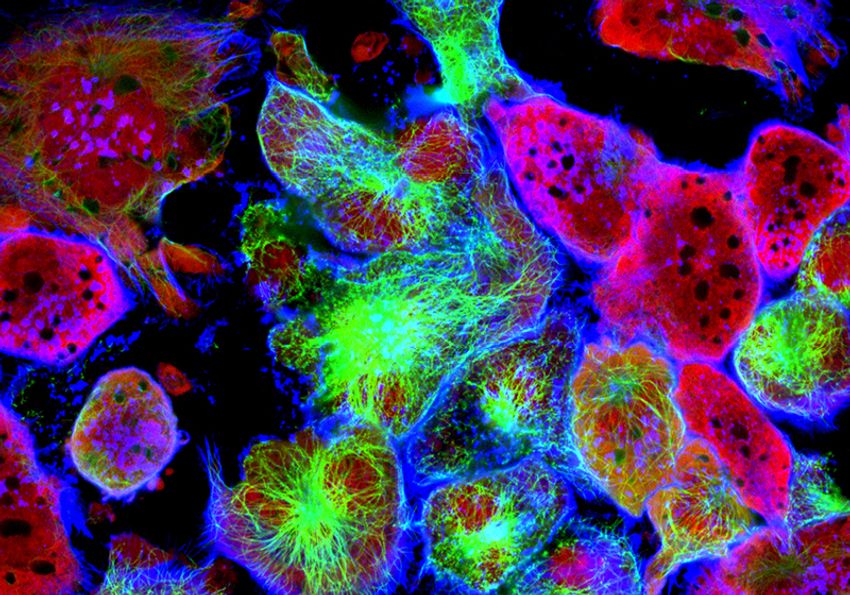 Magnified tumor cells treated with fluorescent dyes