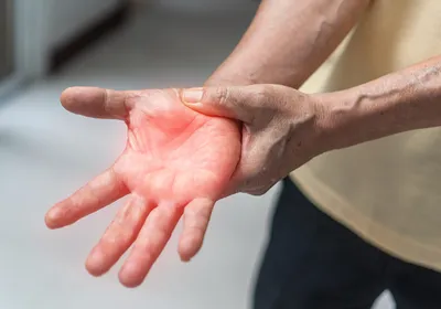 A person holds their right hand, reddened to signify neuropathic pain.