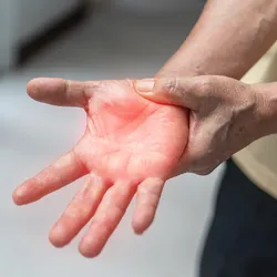 A person holds their right hand, reddened to signify neuropathic pain.