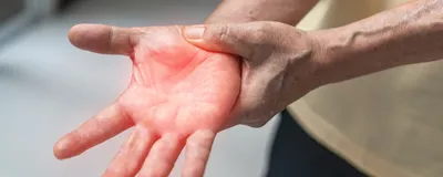 A person holds their right hand, reddened to signify neuropathic pain. A person holds their right hand, reddened to signify neuropathic pain.