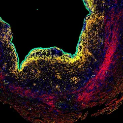 A microscopy image showing a cross-sectional view of endometriosis tissue with red, orange, yellow, and green colors against a black background, signifying information obtained from spatial transcriptomes of endometriomas.