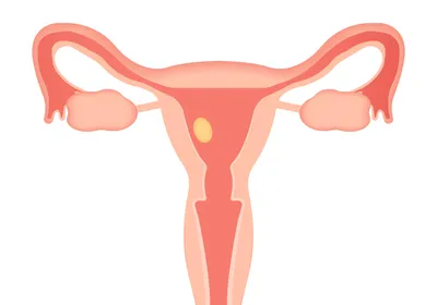 Illustration of a human uterus, fallopian tubes, ovaries, and cervix. The exterior of the tissues are a pale salmon color, and the inside of the organs are a darker pink. Near the endometrium on the left of the uterus is a yellow oval, representing an egg or embryo.
