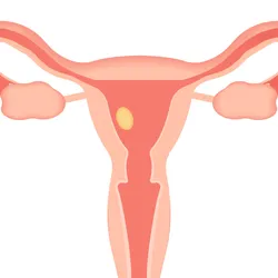 Illustration of a human uterus, fallopian tubes, ovaries, and cervix. The exterior of the tissues are a pale salmon color, and the inside of the organs are a darker pink. Near the endometrium on the left of the uterus is a yellow oval, representing an egg or embryo.