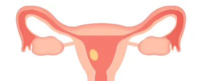 Illustration of a human uterus, fallopian tubes, ovaries, and cervix. The exterior of the tissues are a pale salmon color, and the inside of the organs are a darker pink. Near the endometrium on the left of the uterus is a yellow oval, representing an egg or embryo. 