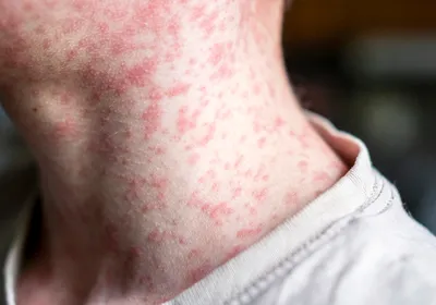 A young boy has a measles rash covering his face and neck.