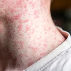 A young boy has a measles rash covering his face and neck.