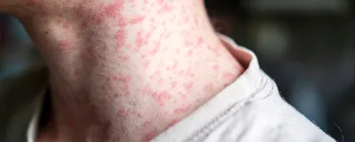 A young boy has a measles rash covering his face and neck.