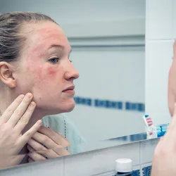 A person looks into the mirror, checking out their eczema flare-up on the face. 
