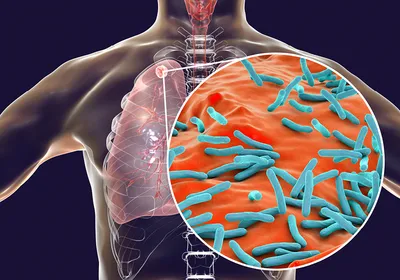 Illustration of lungs within the torso with a magnified section showing blue Mycobacterium tuberculosis on orange lung tissue.