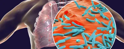 Illustration of lungs within the torso with a magnified section showing blue Mycobacterium tuberculosis on orange lung tissue.