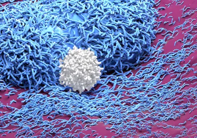 A T cell, shown in white, attacks two solid tumor cells, in blue, on a tissue, colored pink.