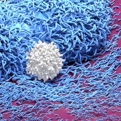 A T cell, shown in white, attacks two solid tumor cells, in blue, on a tissue, colored pink.