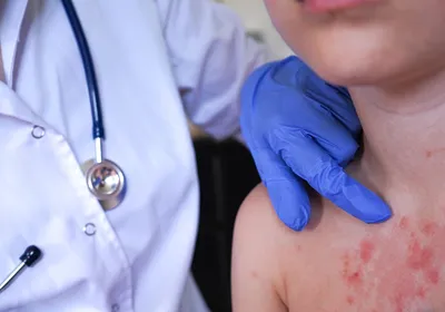 Image of a boy with a splotchy red rash on his chest. There is another figure next to him that is wearing blue nitrile gloves and pointing to the rash.
