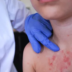 Image of a boy with a splotchy red rash on his chest. There is another figure next to him that is wearing blue nitrile gloves and pointing to the rash.