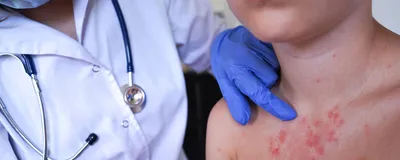 Image of a boy with a splotchy red rash on his chest. There is another figure next to him that is wearing blue nitrile gloves and pointing to the rash.