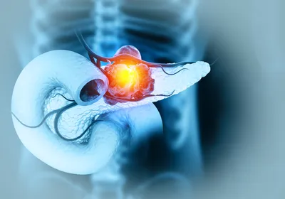 A 3D digital illustration depicting a tumor growing on the human pancreas.