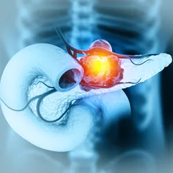 A 3D digital illustration depicting a tumor growing on the human pancreas.