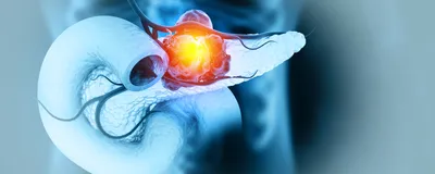 A 3D digital illustration depicting a tumor growing on the human pancreas.